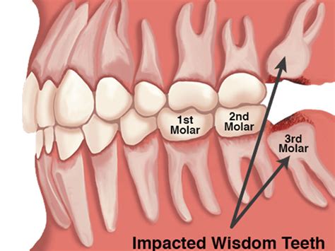 There Difference Between Molars Wisdom Teeth