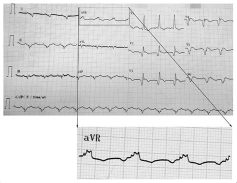 Right axis deviation = qrs axis greater than +90°. The ECG show showed an extreme right axis deviation and ...