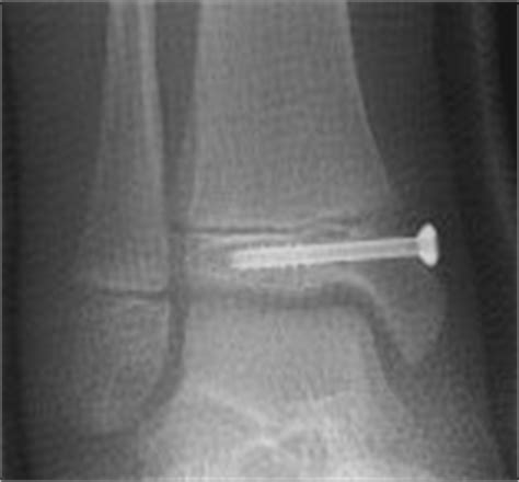 Paediatric ankle fractures