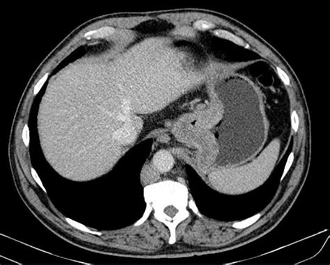 Ct Scan Showing Exuberant Parietal Thickening Of The Cardia Download