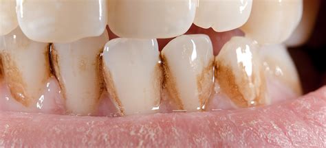 How do you tell the difference between black stains, cavities, discoloration, and other tooth problems? Possible Reasons For Stained or Dis-colored Teeth | Monash ...