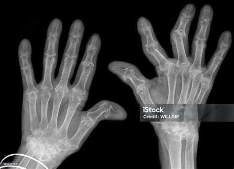 Hand Xrays Showing Advanced Rheumatoid Arthritis Stock Photo Download