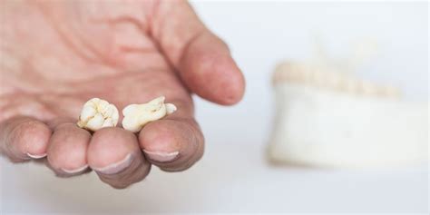 Extractionswisdom Teeth Removal Thornhill Dentist North York
