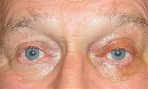 Correction Of Bilateral Drooping Upper Eyelids Ptosis After Nissman Eye