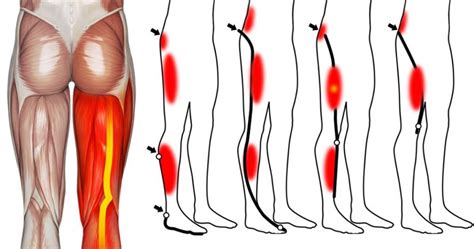 Leg Pain Facts ⋆ Santa Barbara Deep Tissue Riktr Pro Massage Nicola Lmt