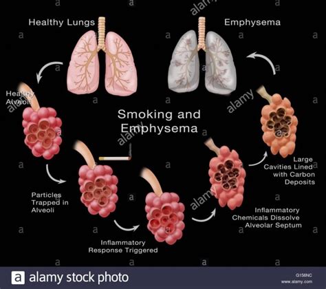 Stages Of Lung Damage Of A Smoker Leading To Emphysema The Stock Best