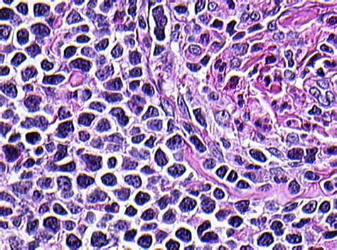 Pathology Outlines Mantle Cell Lymphoma Mcl Mantle Classic