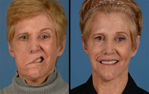 How Susan Got Her Smile Back A Journey Overcoming Facial Paralysis Plastic Surgery UT