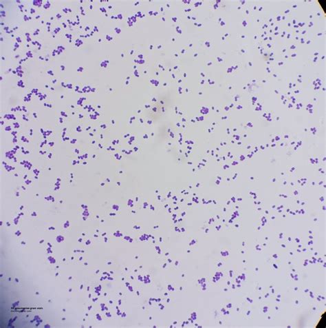 Streptococcus Pneumoniae Gram Stain Ebonydadson
