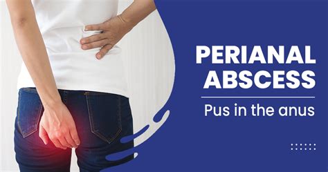 Perianal Abscess Causes Symptoms Risk Factors And Treatments