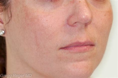 Photofacial For Sun Damage Treatment Woodlands Tx Houston