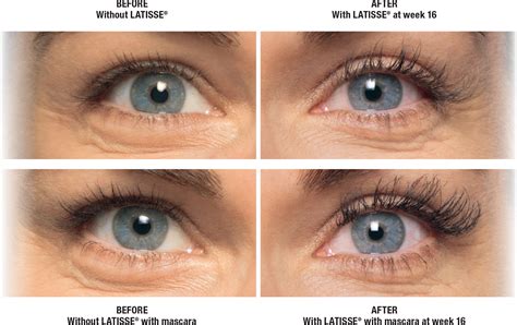 Sofort ergebnisse aus mehreren quellen! Latisse San Diego | La Jolla Cosmetic Surgery Centre