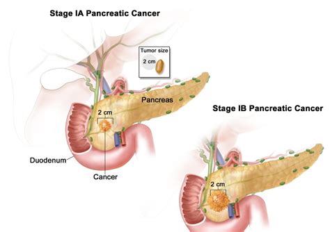 Most often these are young patients with good general health. 30 Signs and Symptoms of Pancreatic Cancer - Fallbrook247