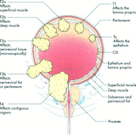 Use of bacille Calmette-Guérin in superficial bladder ...
