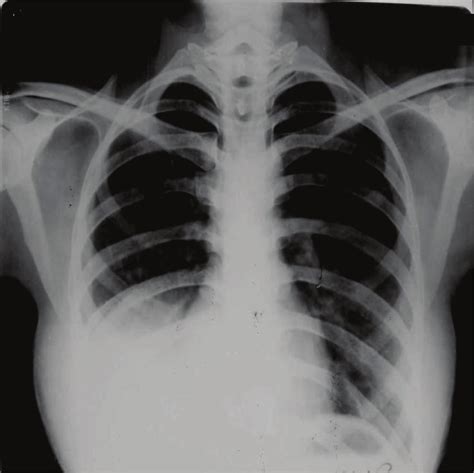 Chest Xray Posteroanterior View Taken 6 Months Prior To Presentation