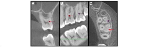 Cbct Images Of A Left Maxillary First Molar Red Arrows And Left