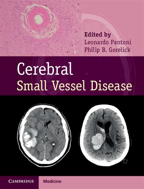 Small Vessel Ischemic Disease Cerebral Csvd Vascular Svn Bmj Diseases