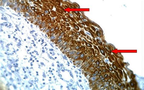 Hsil Of The Uterine Cervix Showing Brown Staining Of Cytoplasm With