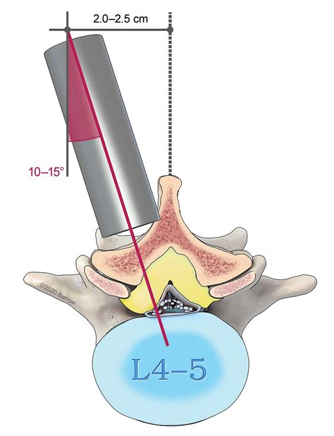 Minimally Invasive Spine Surgery Neuro Rehabilitation Barrow