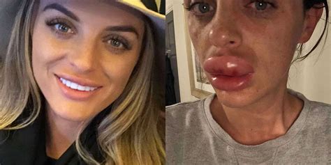About two days after lip filler injections, you'll likely start to notice the swelling is going down. Pin on Competition module