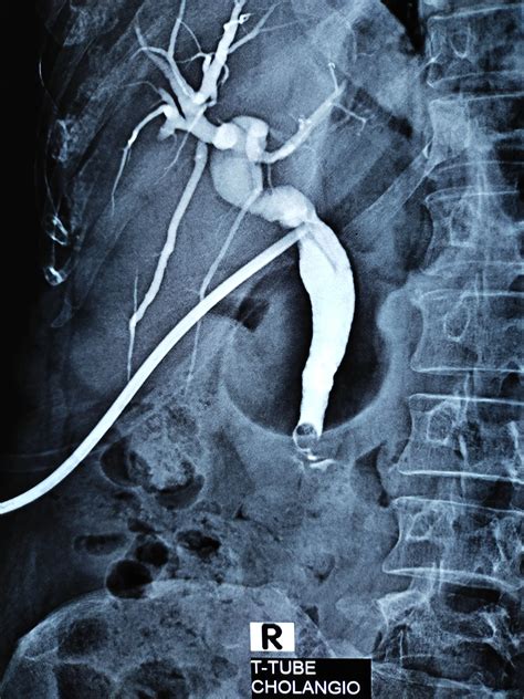 T Tube Cholangiogram With Retained Stone Dr Masfique A Bhuiyan Dr