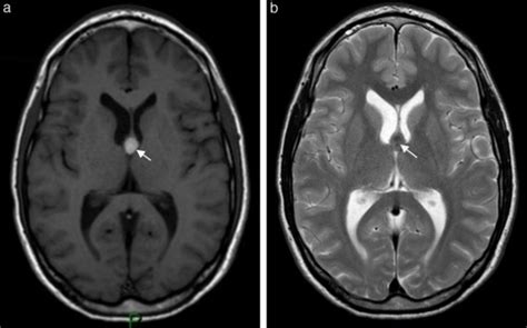 La Rm En Ponderación A T1 Y B T2 En Corte Axial Muestra Una