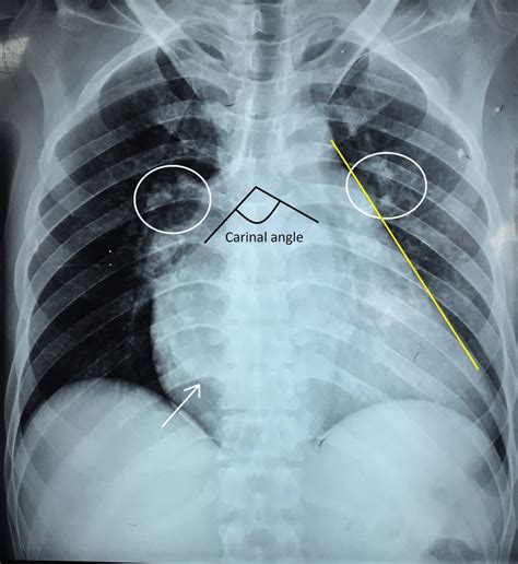 Chest Radiograph Posteroanterior View Showing Cardiomegaly With