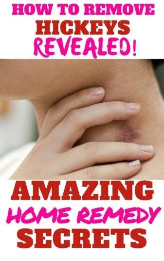 We did not find results for: DIY How to Remedy Hickeys | Hickey remedies, Remedies, Hickeys