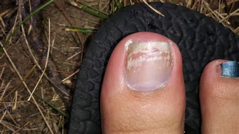Toenail Loss And Regrowth Over 14 Months Youtube