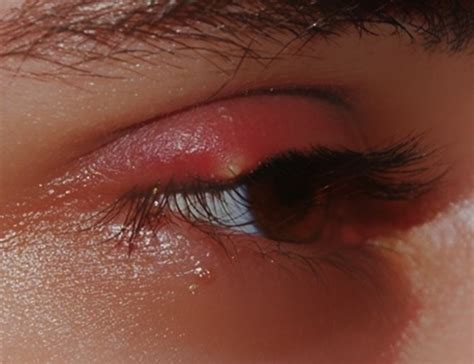 White Bump On Eyelid Causes Treatment Remedies Pictures