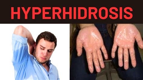 Hyperhidrosis Causes Symptoms Treatment Types Youtube