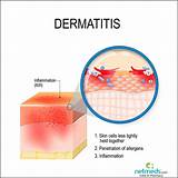 Irritation is also usually fairly quick, whereas allergic contact dermatitis. Contact Dermatitis: Causes, Symptoms and Treatment | Netmeds