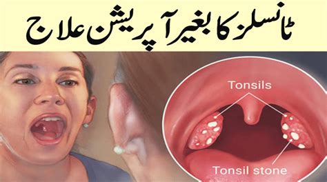 Get Rid Of Tonsils By Natural Home Remedies