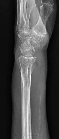 Radiography Of Subtle Wrist Fractures Wikiradiography