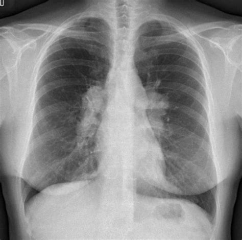 Cxr And Sarcoidosis Lungs