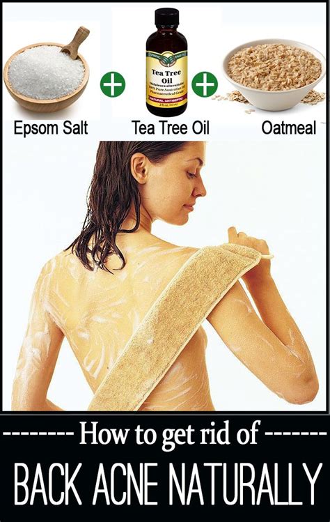 18 Home Remedies For Back Acne Natural Acne Remedies Back Acne
