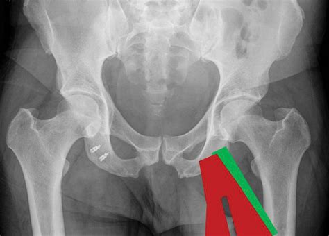 Gracilis und semitendinosus ist diese ein teil einer gemeinsamen sehne. Sehne reißt direkt am Becken aus | SpringerLink