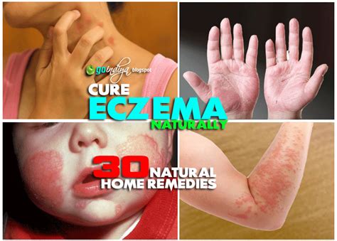 30 Natural Home Remedies For Eczema Atopic Dermatitis In Kids