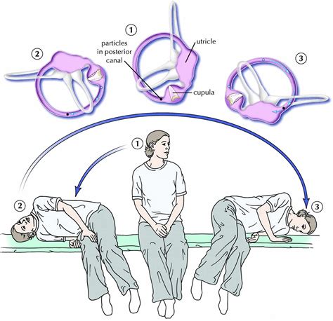 Epley Maneuver Instructions How To Do The Epley Maneuver