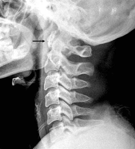 Lateral Radiograph Of Cervical Spine Shows A Well Corticated Bone
