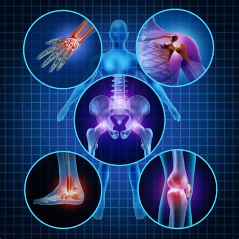 Cuáles Son Los Síntomas De La Osteoporosis 6 Pasos
