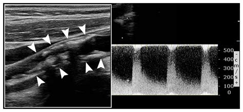 Carotid Stenosis NEJM