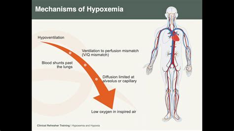 Hypoxemia And Hypoxia Youtube