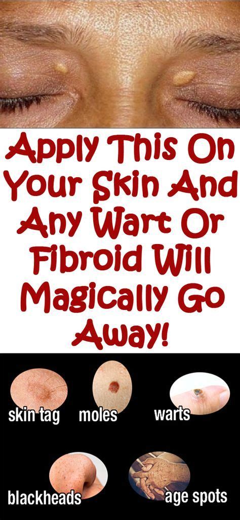 How To Remove Warts Skin Tags On Eyelids Howotremvo