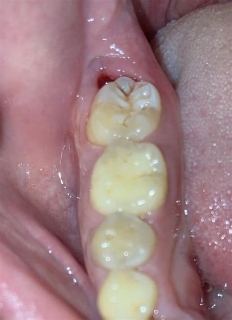 Hole In The Gums Behind My Molars How Urgently Should I Seek Dental