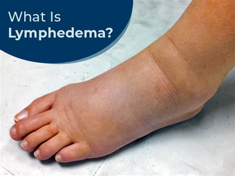 Lymphedema Lymphatic Dysfunction Types Causes Symptoms Risk