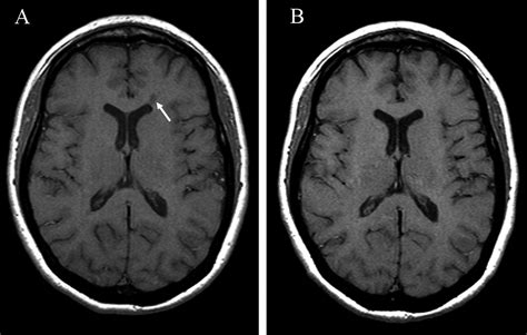 New Acute And Chronic Black Holes In Patients With Multiple Sclerosis