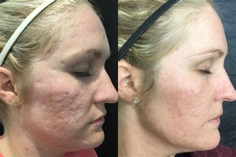 Microneedling Before And After Bella Vi