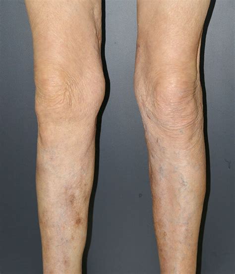 Varicose Vein Treatment Melbourne Causes And Aftercare Tips