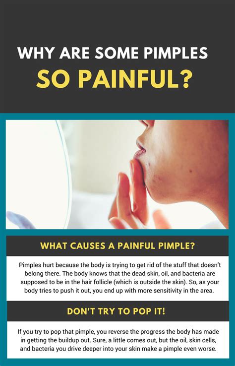 Unique 35 Of Why Do Blind Pimples Hurt Freeflytonedownload